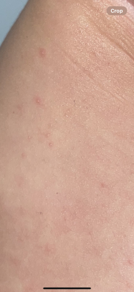 Is this all chickenpox is?