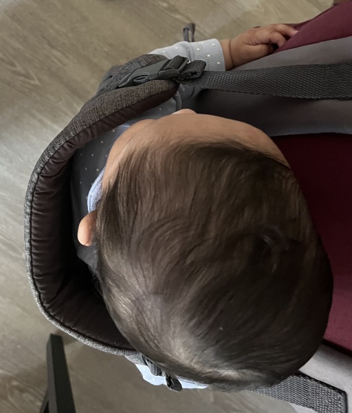 Plagiocephaly- How severe Is this please?