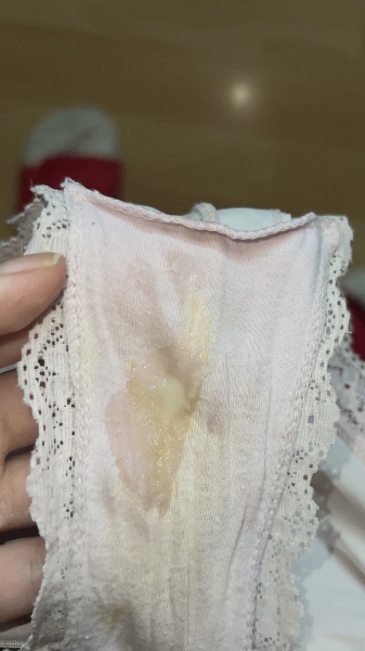 Pale yellow discharge