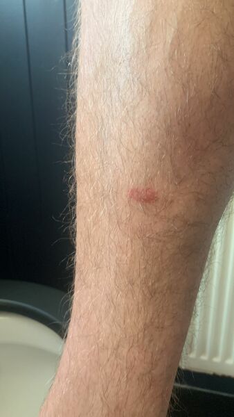 Tick bite ?