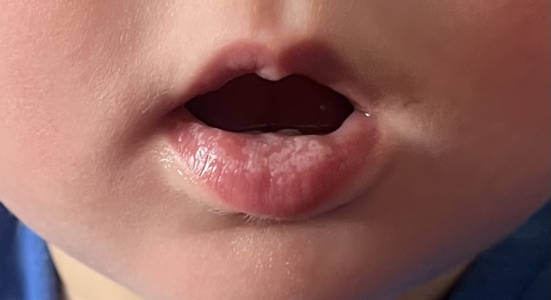 What is this on my babies lip?