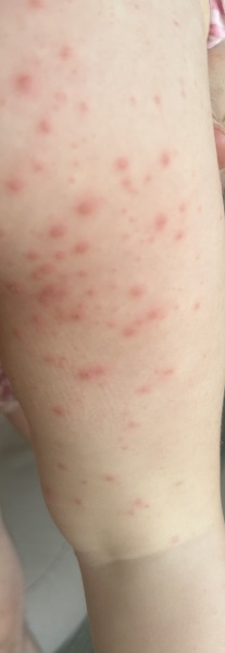 Rash - any thoughts?