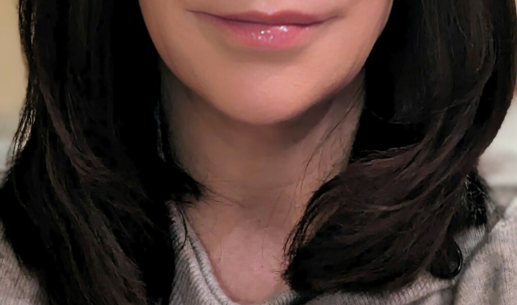 Filler or thread lift