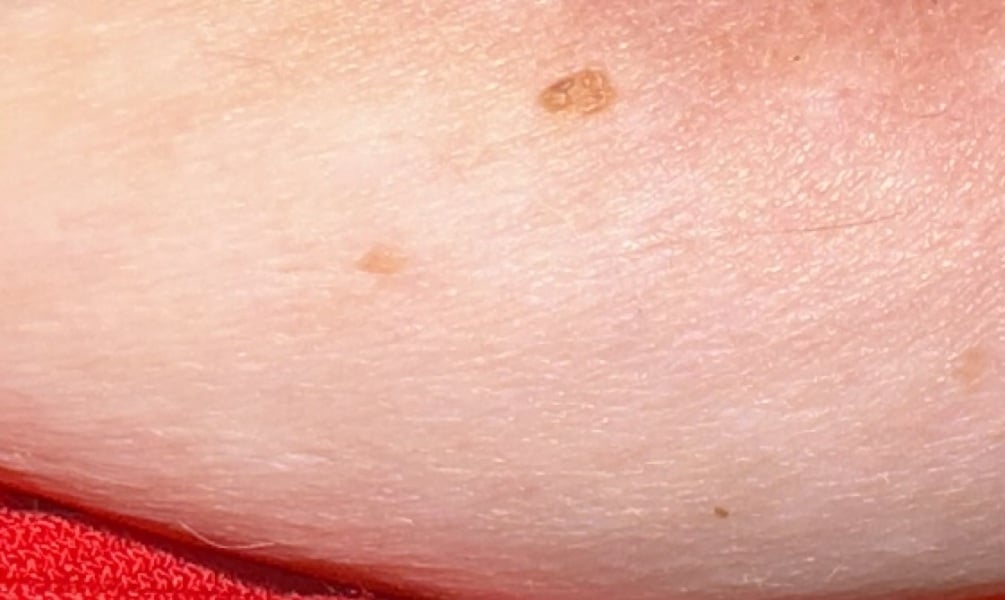 Does this mole look normal?