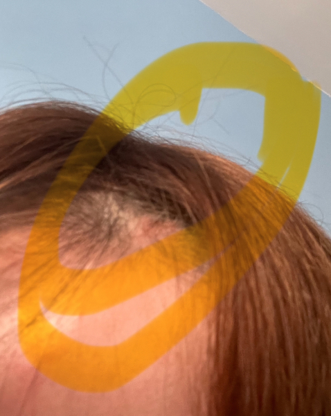 Scalp injury ( photos included )