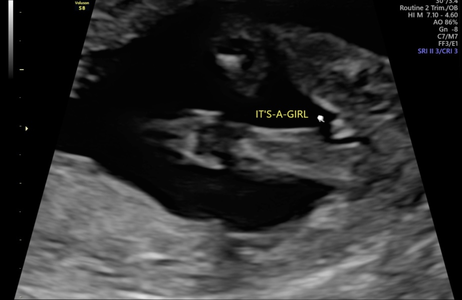 Gender confirmation
