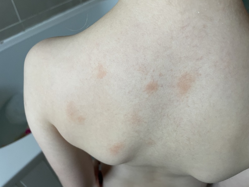 What’s this rash?