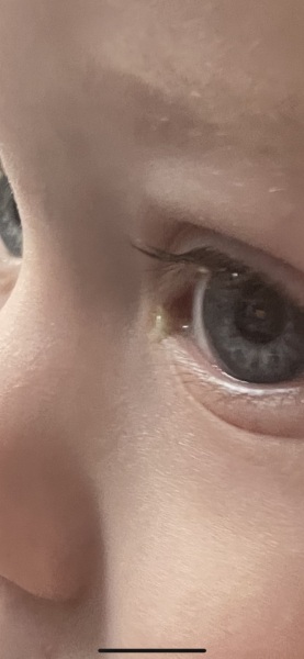 Bacterial or viral conjunctivitis