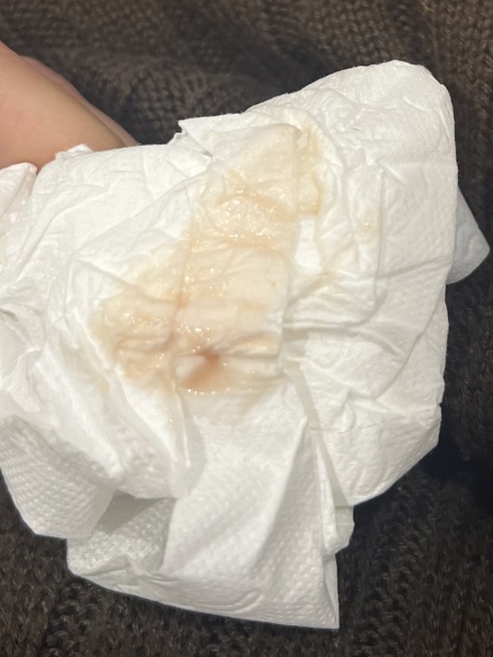 Bleeding 6 weeks! Pic included - baby had a heartbeat this week