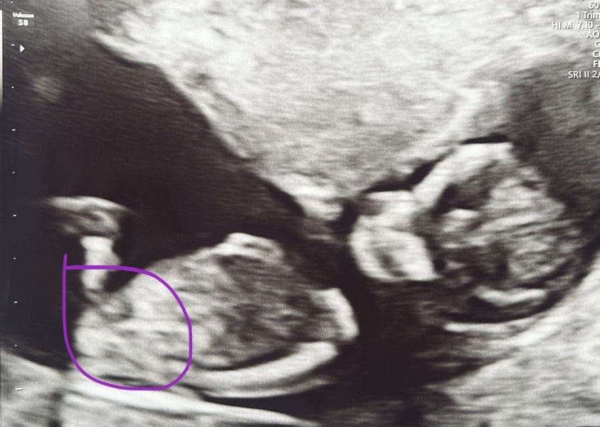 12+5 scan - is it a boy?!
