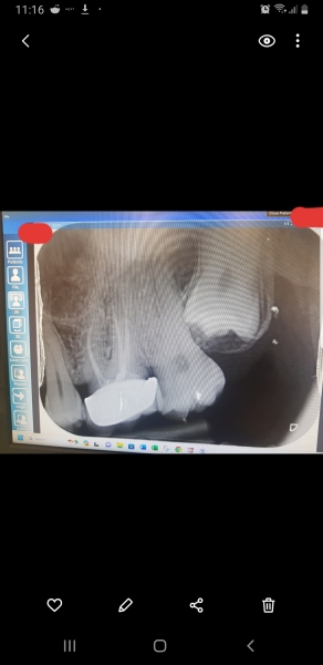 Do you think this root canal is infected?