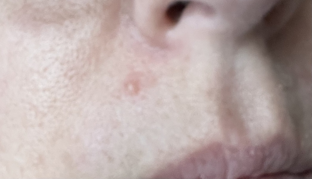Skin tag on face? Pic included!