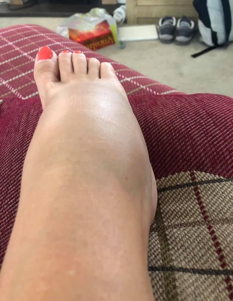 Pic of DH foot, shall he go back to be checked out again?