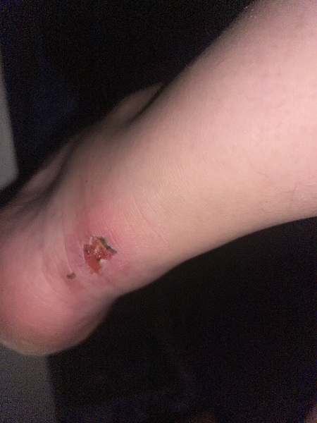 What’s up with my blister? Pic included