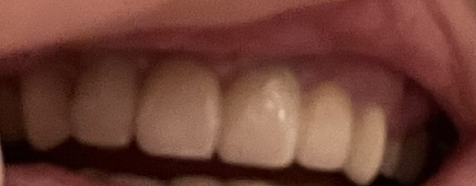 If you’ve had an implant on a front tooth, how does it look?