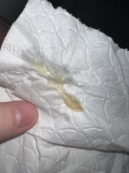 TTC and increased discharge