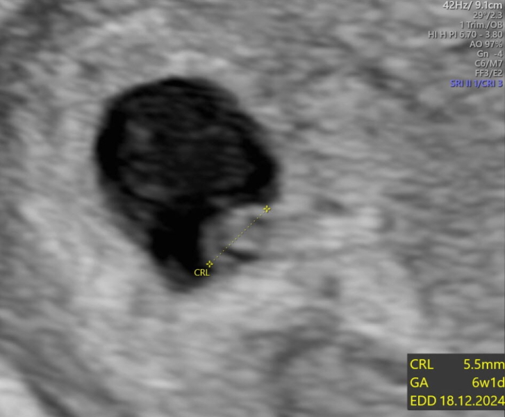 Scan at 8 weeks 2 days. Meeasuring at 6 weeks 1day.