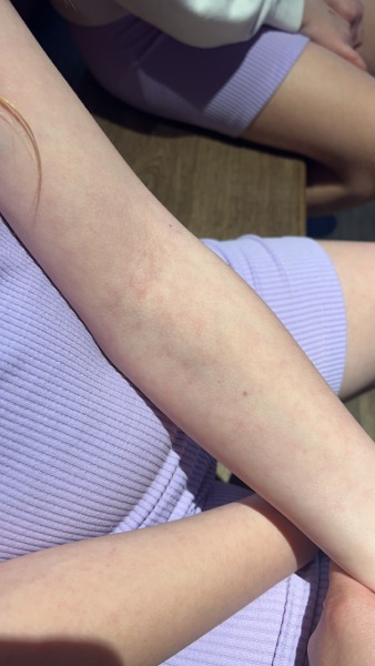Help me figure out this rash…