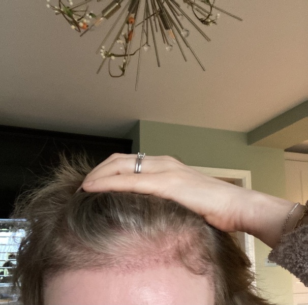 I’ve just had a hair transplant AMA