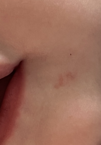 Red bumps around baby mouth