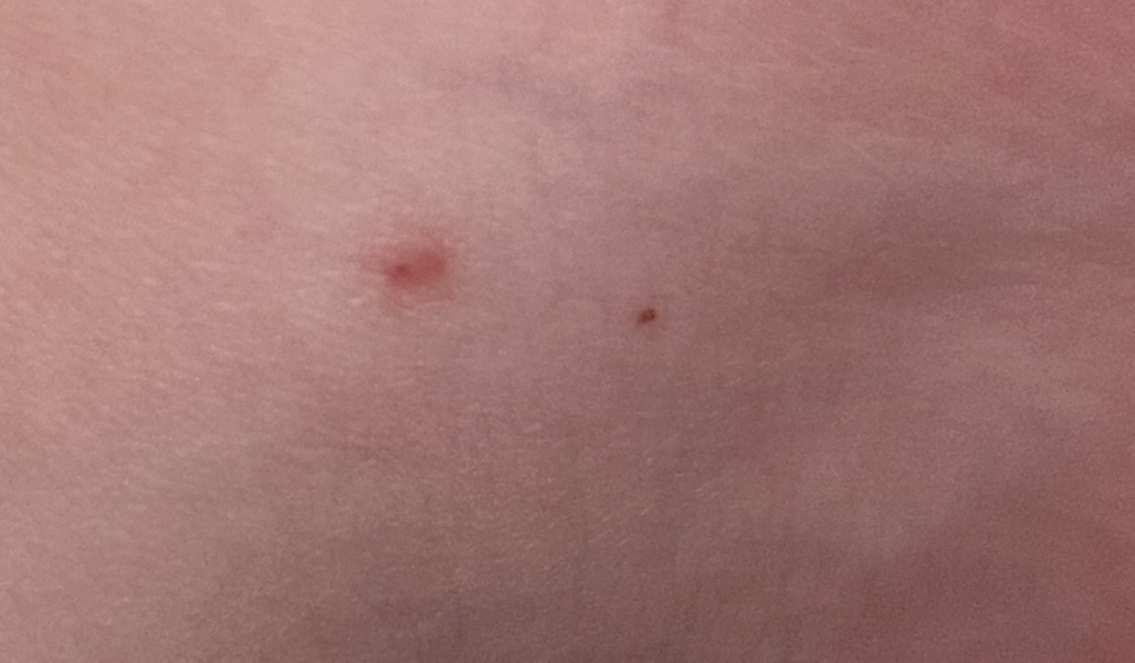 Flea bites?!
