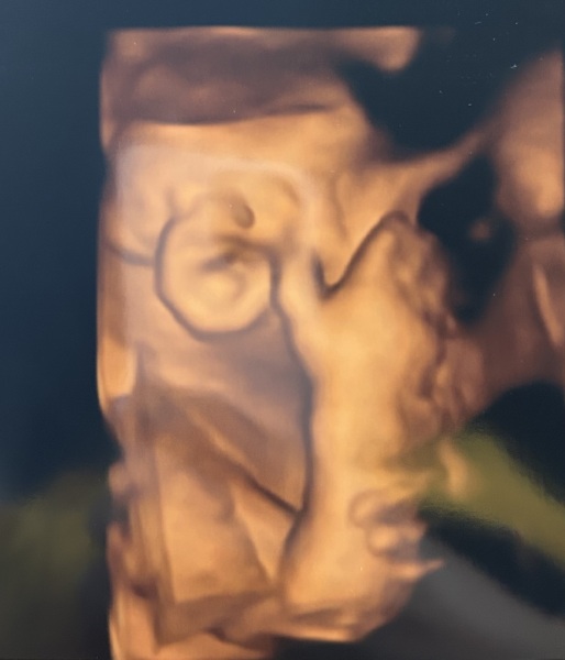 4D scan - 32 weeks! Giant ears ?!