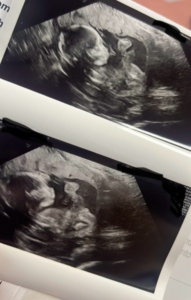 Excited to know girl or boy ..any guesses please 😇