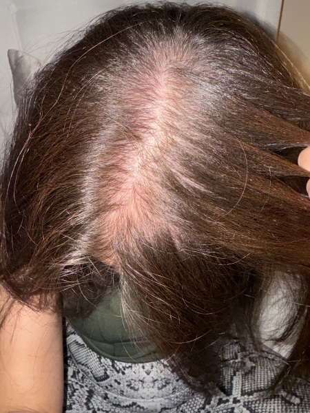 Flaky, scaly scalp.