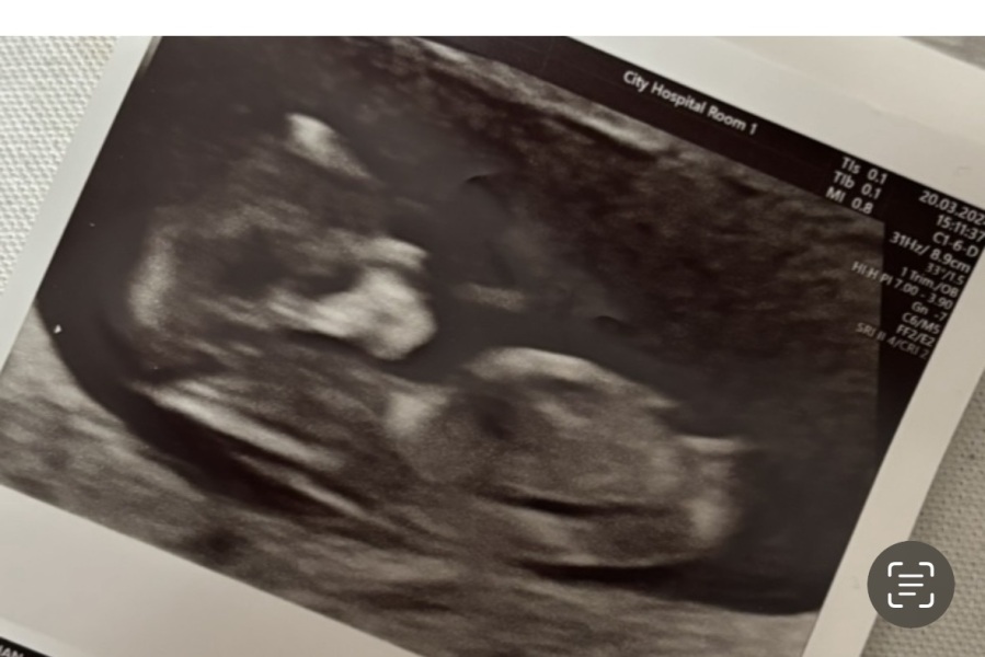 Nub theory guesses? Girl or boy?