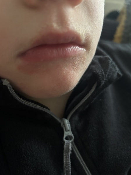 Is this impertigo? Pic included