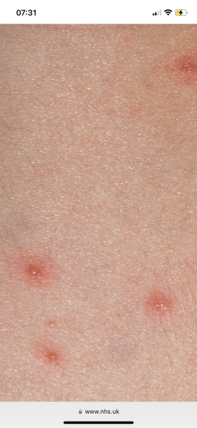 Is this all chickenpox is?