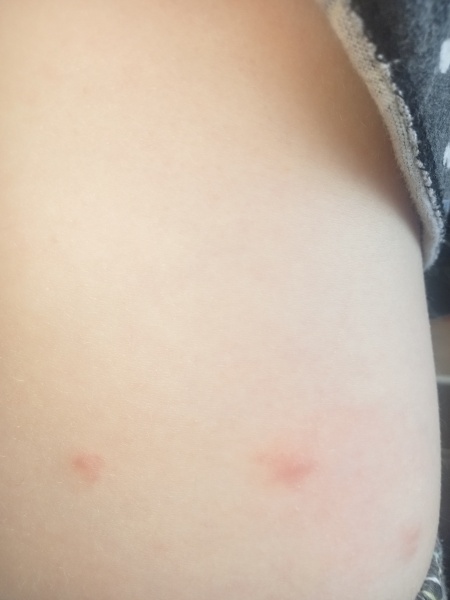 Is this chickenpox?