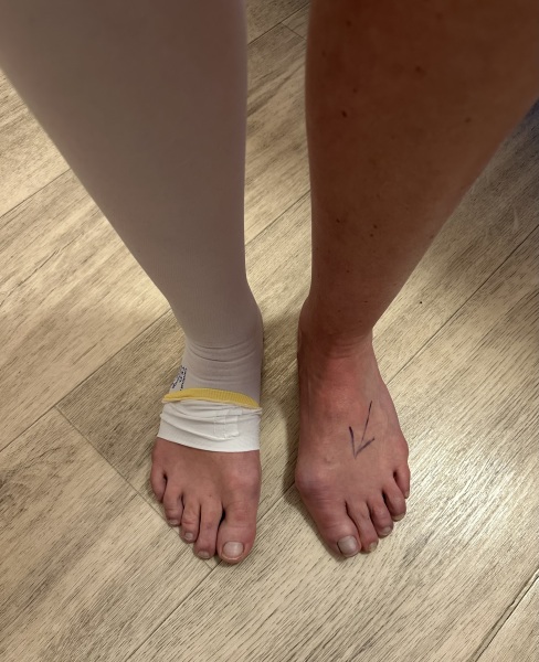 Bunion Keyhole surgery