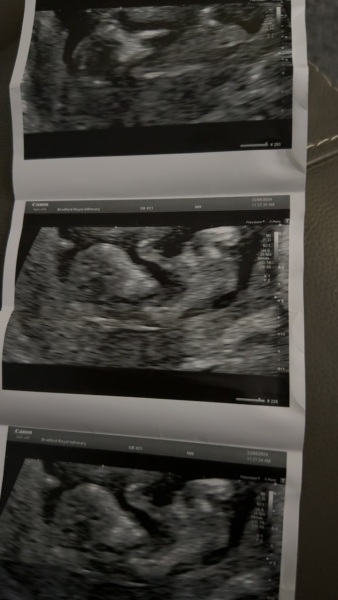 12 week scan