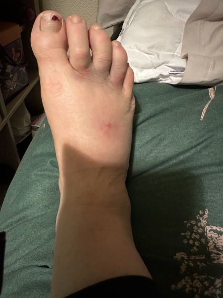 What's your stupidest injury?