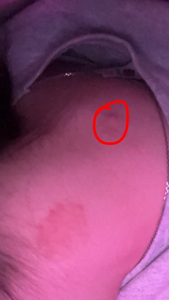 To be concerned about this lump…