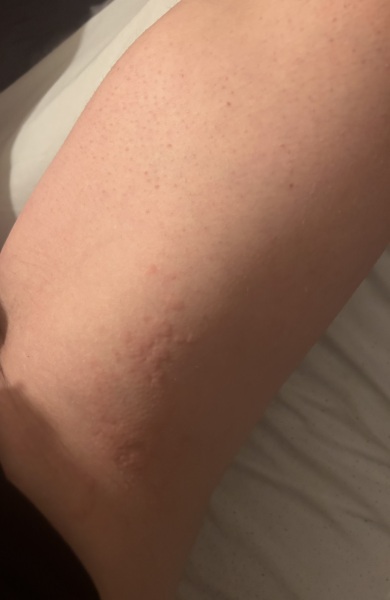 Hives every night (pic)