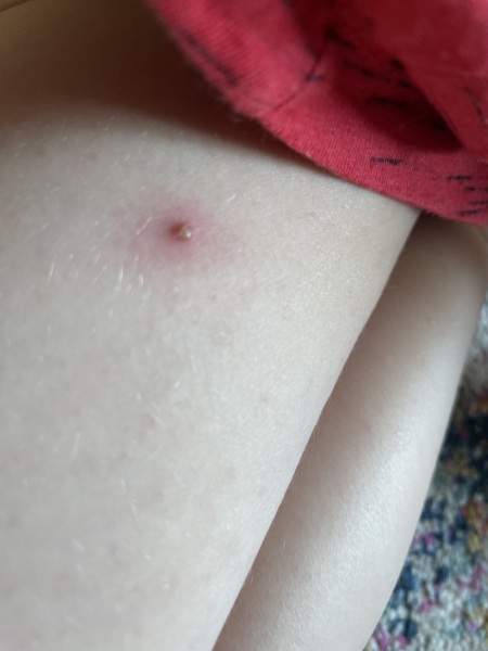 My 3 year old is getting acne