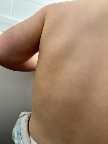 Chicken pox or something else?