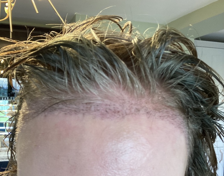 I’ve just had a hair transplant AMA
