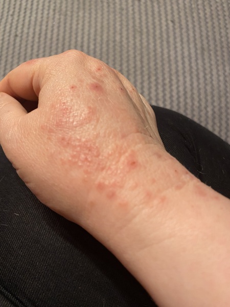 Does this look like scabies?