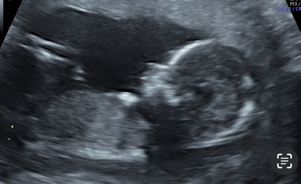 15 week scan help?