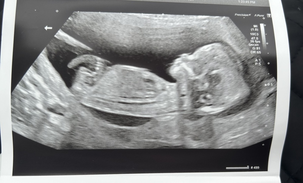 Boy or girl? Guesses :)