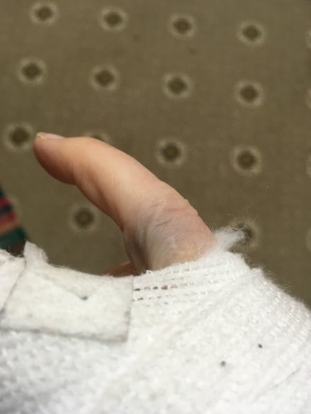 Does anyone get small burst blood vessels in their fingers?
