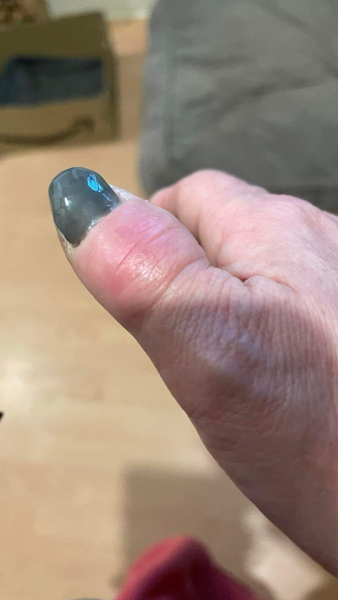 Allergic to gel nails - advice please