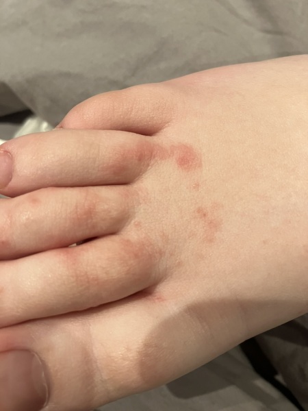 Rash on foot of 10 year old