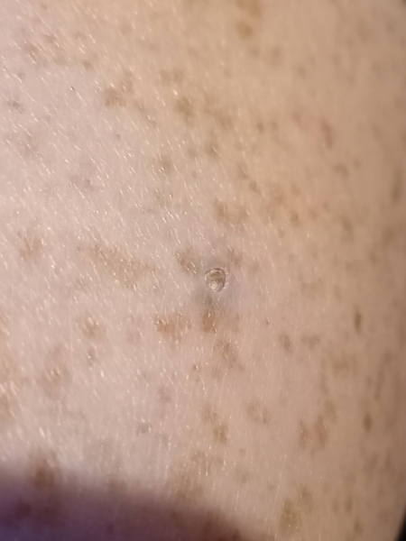 If you ignored an ingrown hair for years, would it look like this?