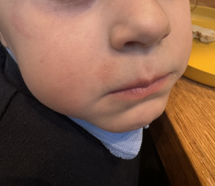 Seborrheic dermatitis - Help