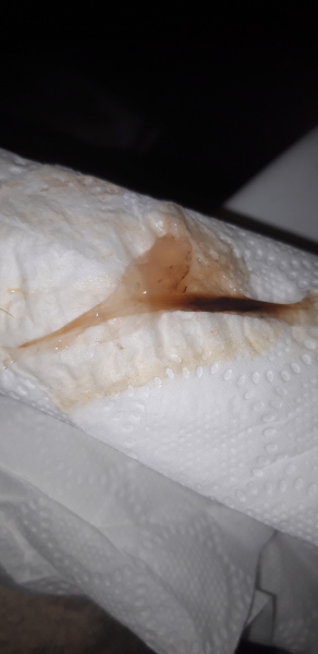 Implantation bleed ? Pic