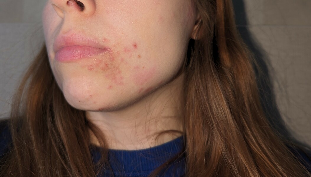 What is this rash/acne??